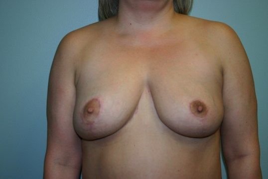 Breast Reduction Before & After