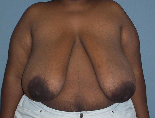 Breast Reduction Before & After