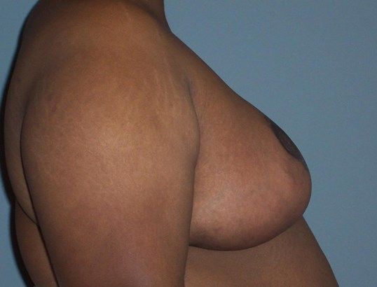 Breast Reduction Before & After