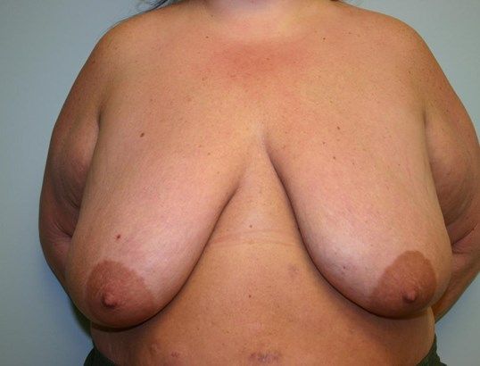 Breast Reduction Before & After