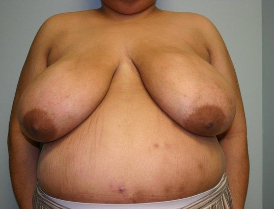Breast Reduction Before & After