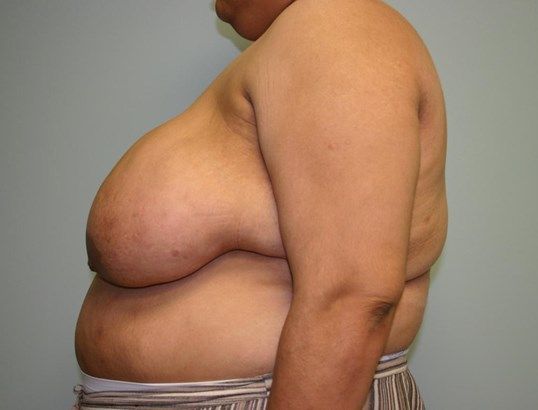 Breast Reduction Before & After