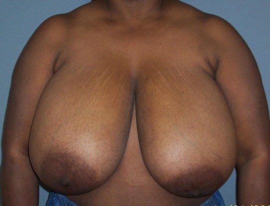 Breast Reduction Before & After