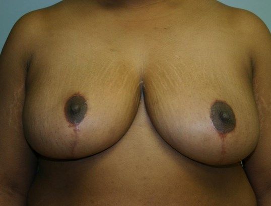 Breast Reduction Before & After