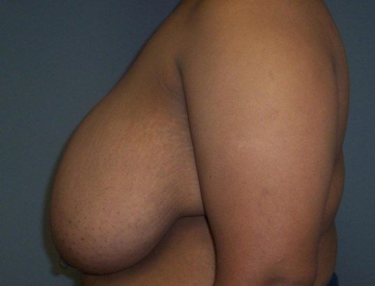 Breast Reduction Before & After
