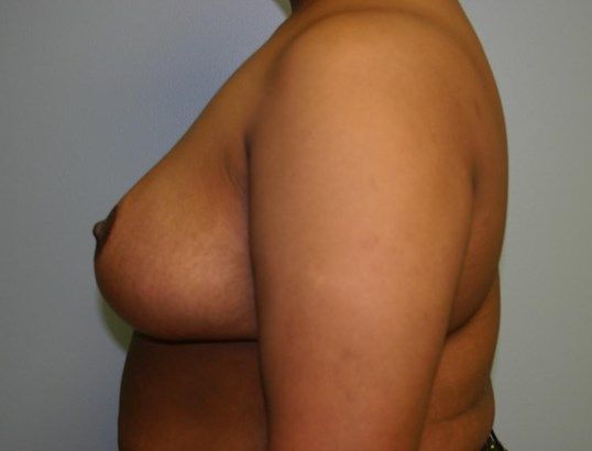 Breast Reduction Before & After
