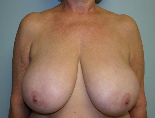 Breast Reduction Before & After