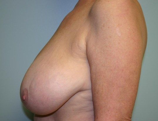 Breast Reduction Before & After