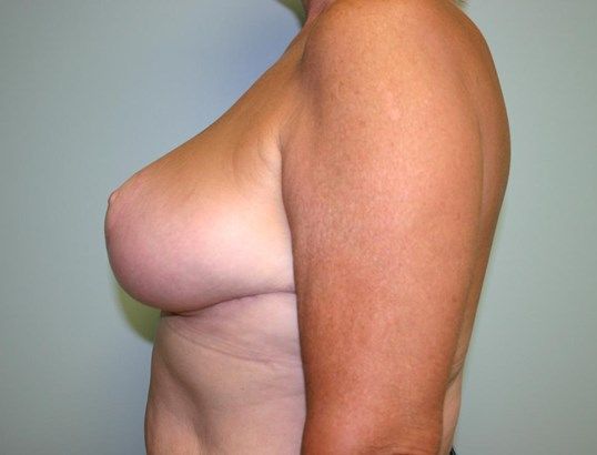 Breast Reduction Before & After