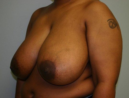 Breast Reduction Before & After
