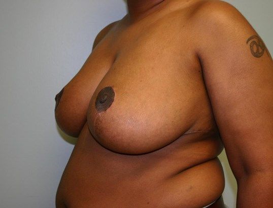 Breast Reduction Before & After