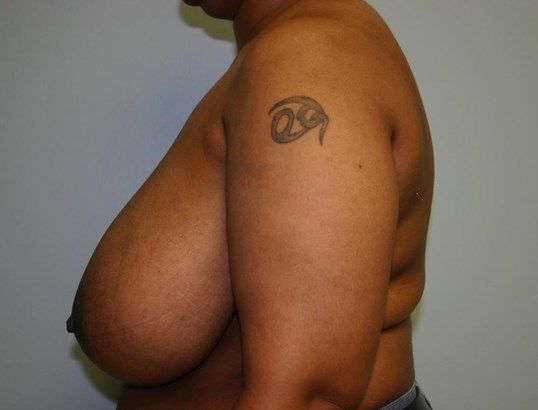 Breast Reduction Before & After