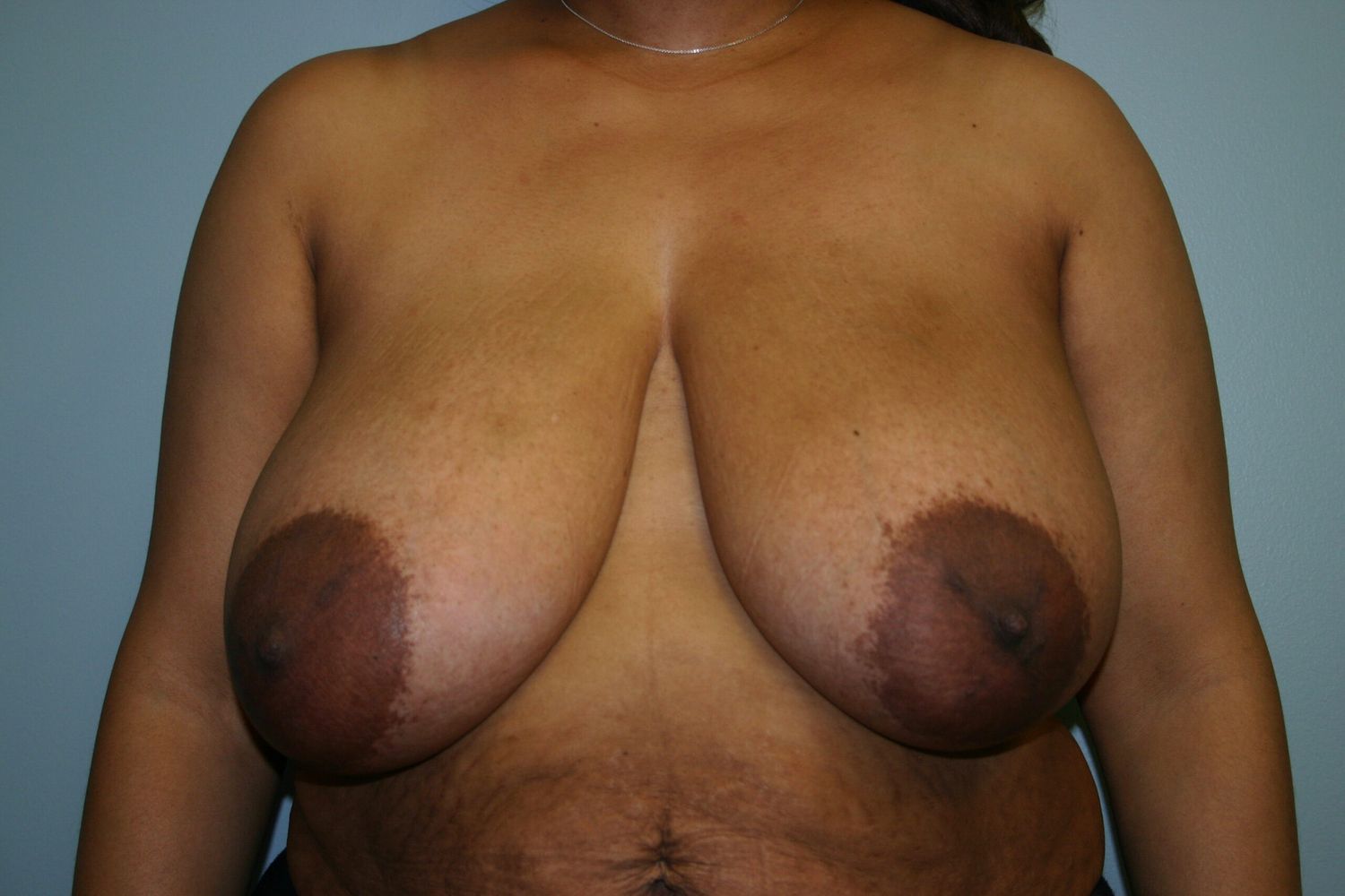 Breast Reduction Before & After