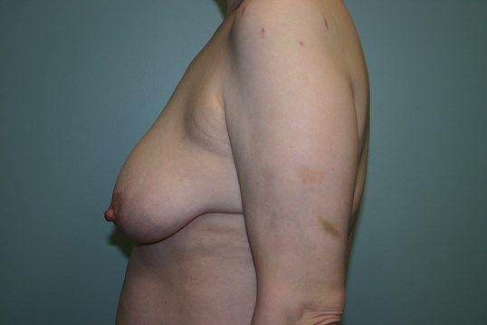 Breast Reduction Before & After