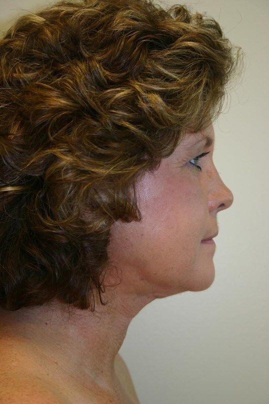 Injectable Fillers Before & After