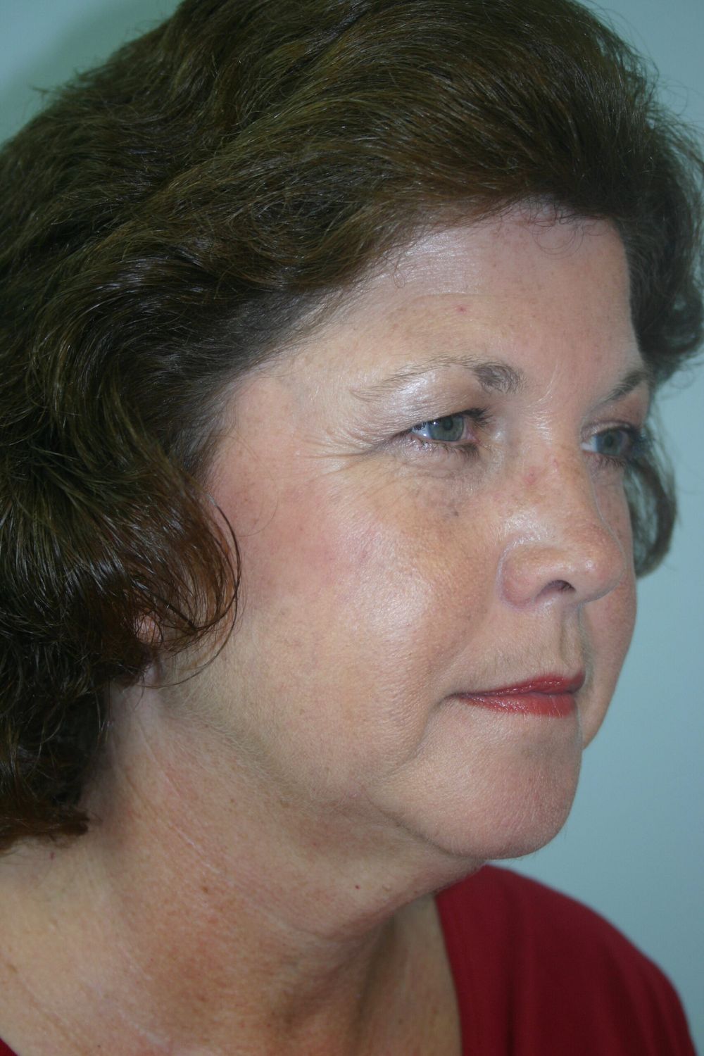 Injectable Fillers Before & After