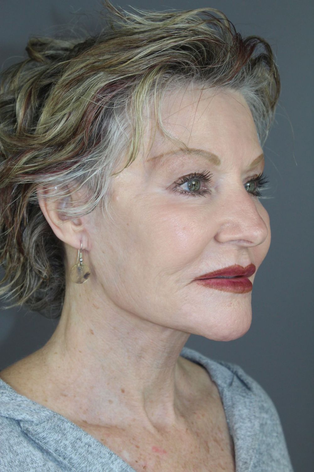 Injectable Fillers Before & After