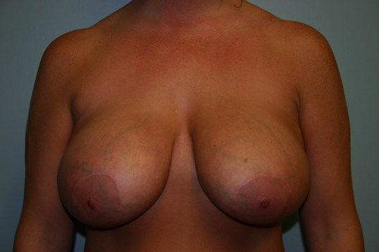 Breast Revision Before & After