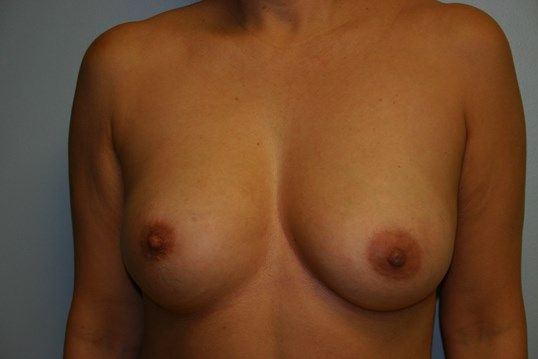 Breast Revision Before & After