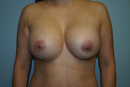 Breast Revision Before & After