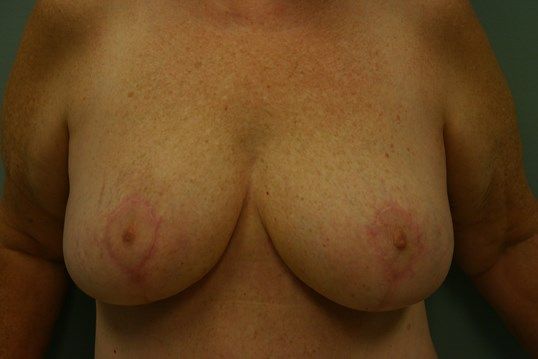 Breast Revision Before & After