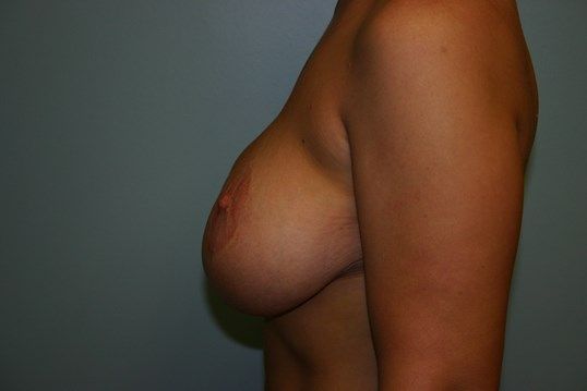 Breast Revision Before & After