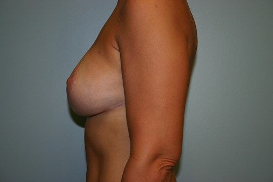 Breast Revision Before & After