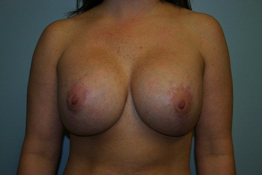 Breast Revision Before & After