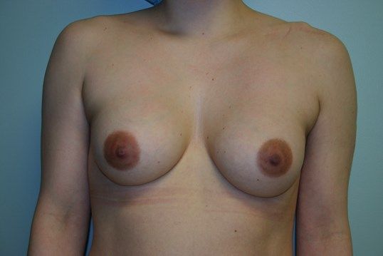 Breast Revision Before & After