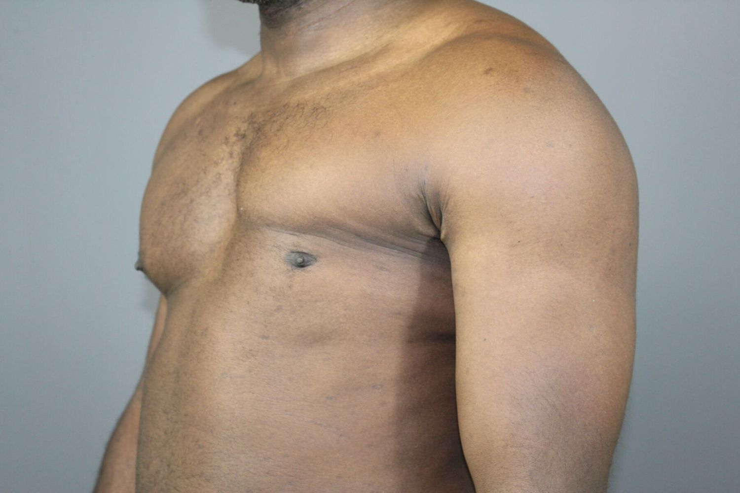 Polands Syndrome Before & After