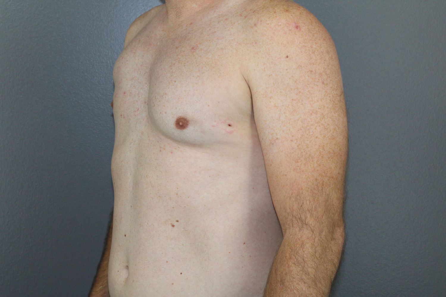 Polands Syndrome Before & After