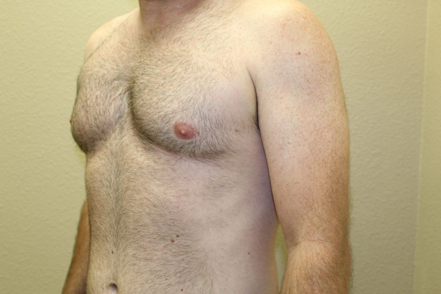 Polands Syndrome Before & After