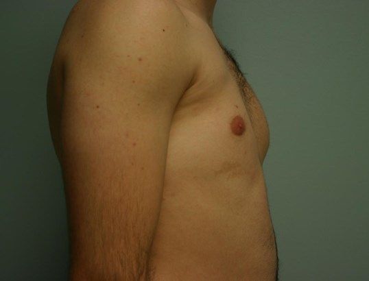 Polands Syndrome Before & After