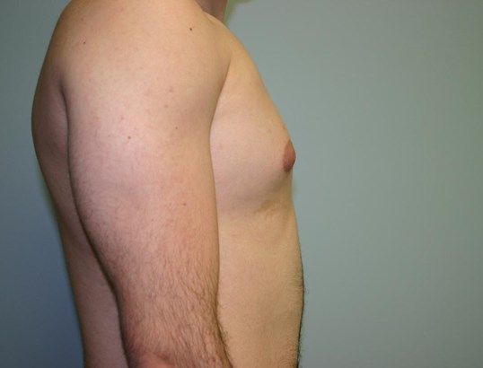 Polands Syndrome Before & After