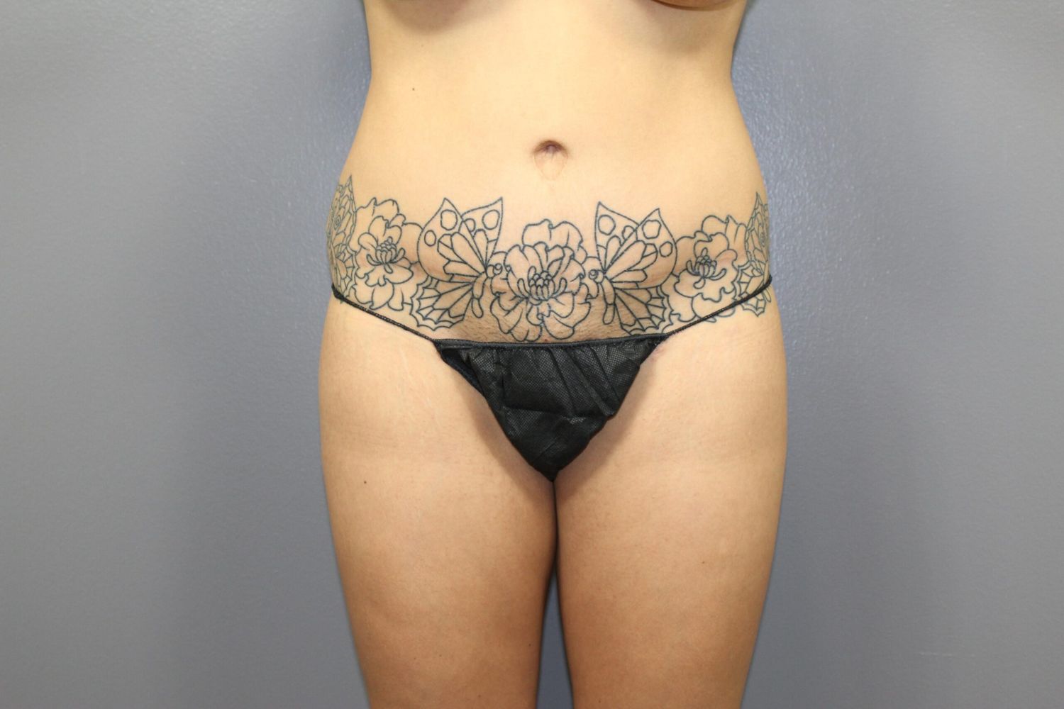 Renew You Before & After