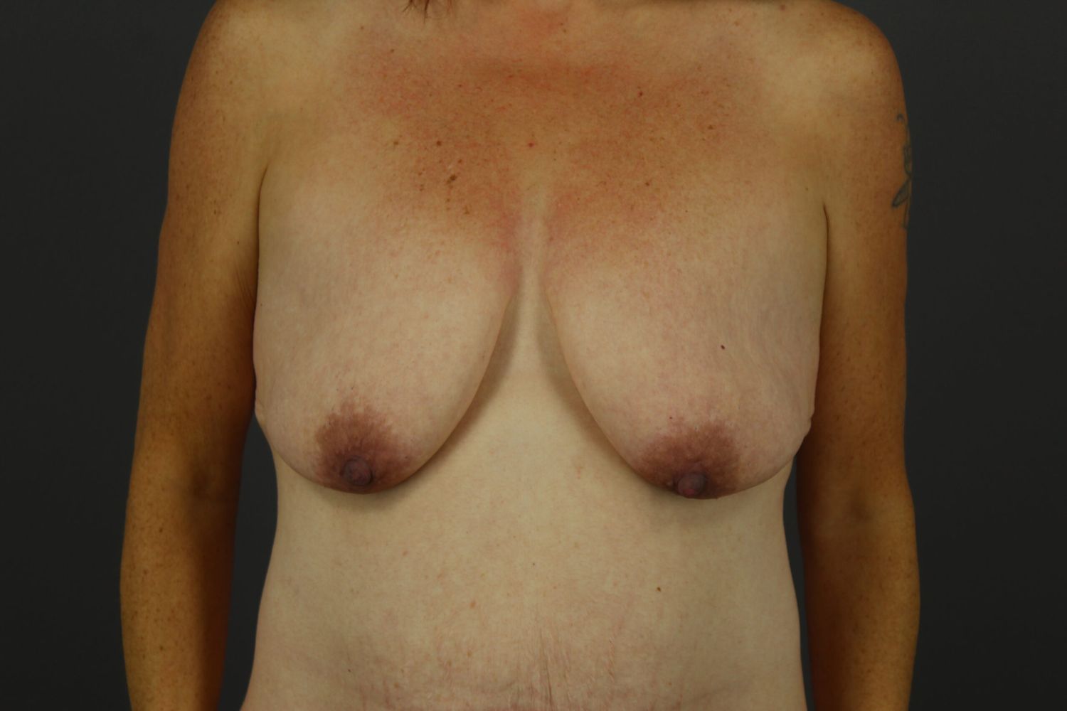 Breast Lift Before & After
