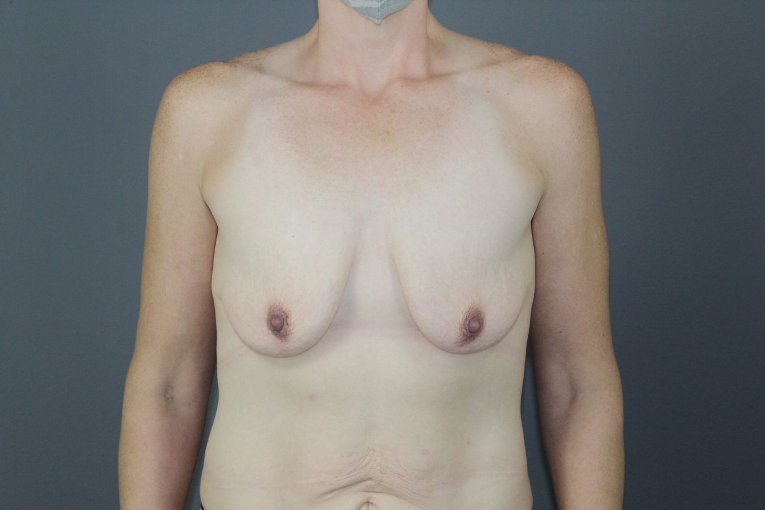 Breast Lift Before & After