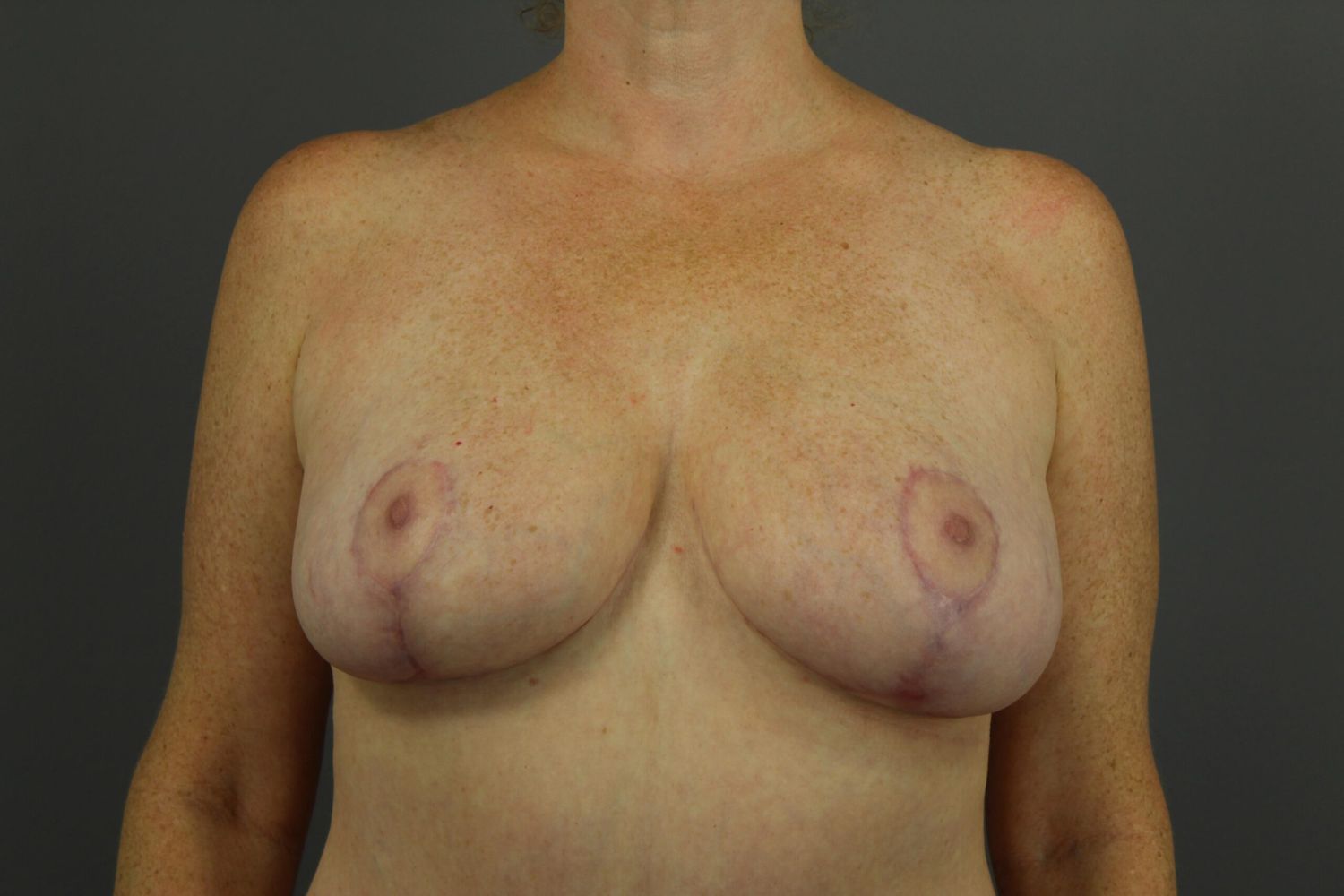 Breast Lift Before & After