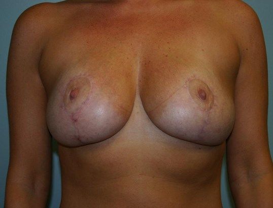 Breast Lift Before & After