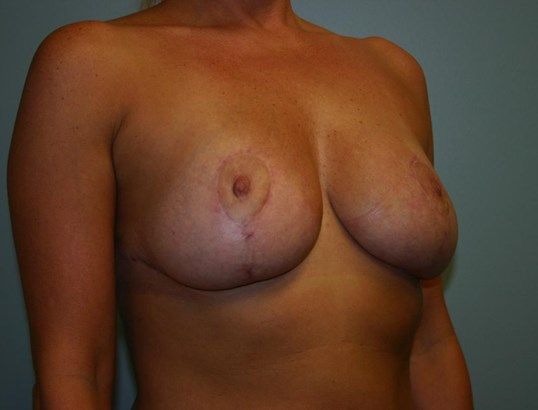 Breast Lift Before & After
