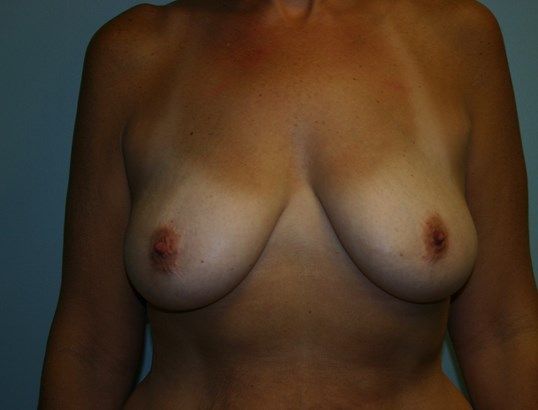 Breast Lift Before & After