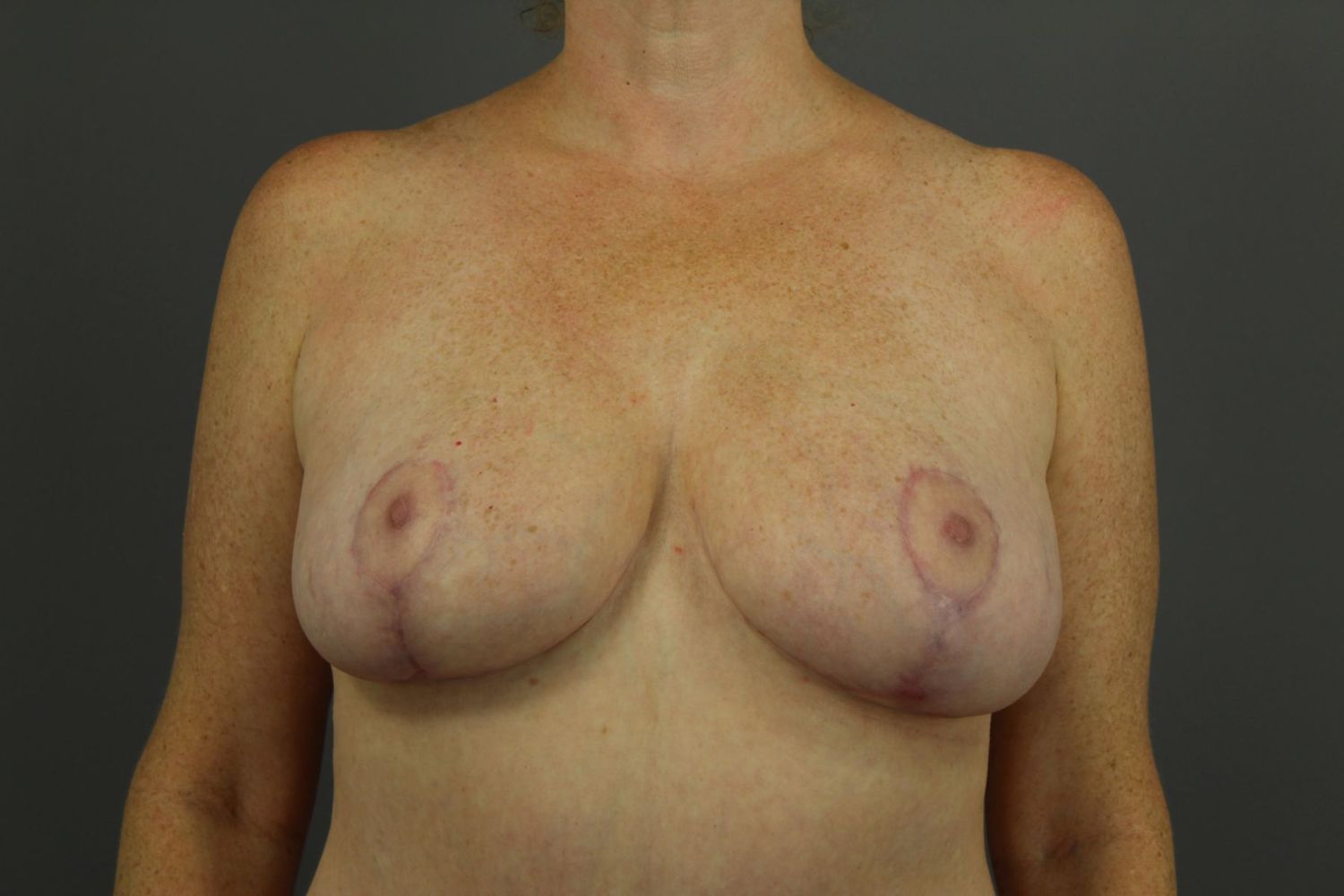Breast Lift Before & After