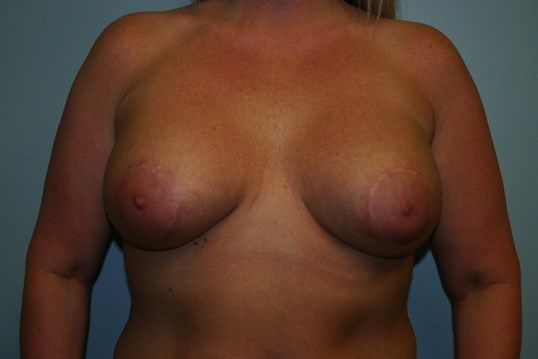 Breast Lift Before & After