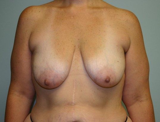 Breast Lift Before & After