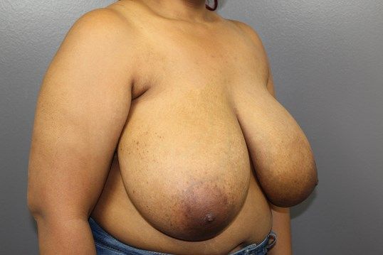 Breast Lift Before & After