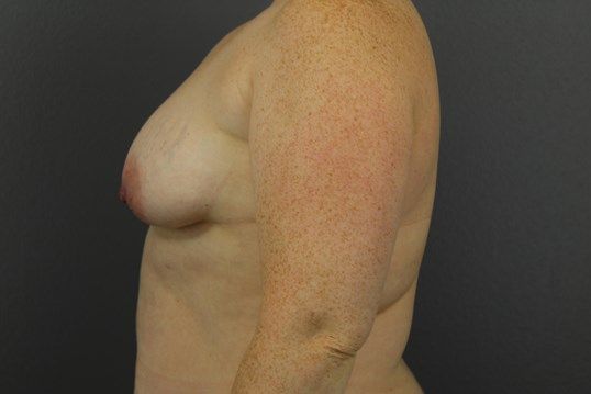 Breast Lift Before & After