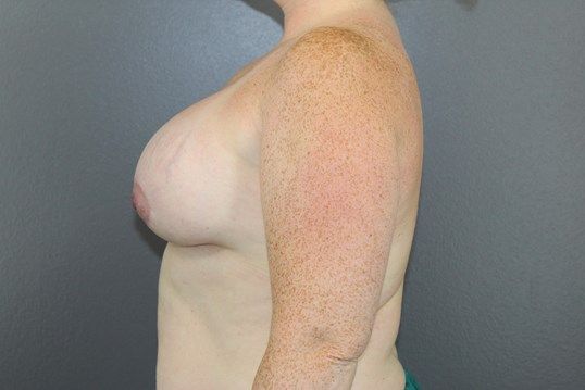 Breast Lift Before & After