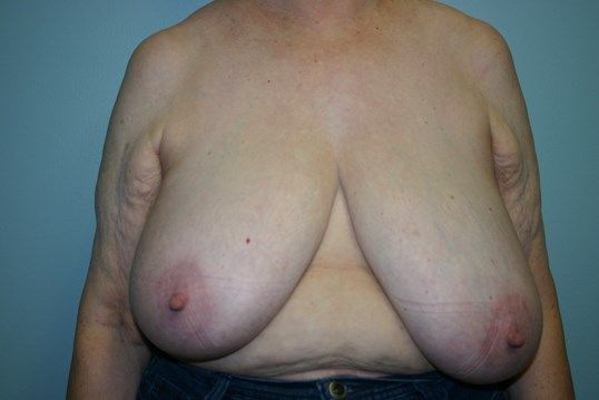 Breast Lift Before & After
