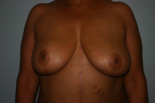 Breast Lift Before & After