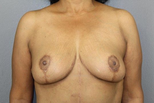 Breast Lift Before & After